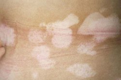 散發型白癜風有哪些危害 散發型白癜風有哪些危害